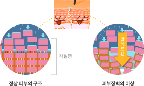 정상 피부의 구조, 피부장벽의 이상 비교 이미지