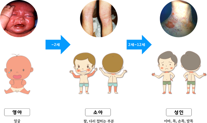 영아 : 얼굴 > ~2세 > 소아 : 팔, 다리 접히는 부분 > 2세~12세 > 성인 : 이마, 목, 손목, 발목