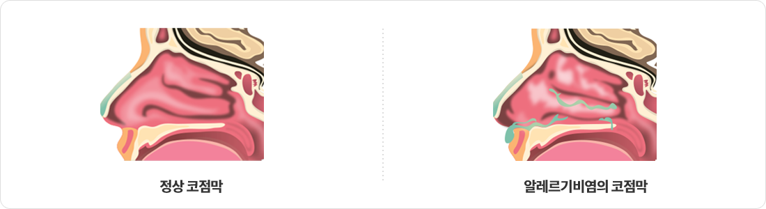 왼쪽 : 정상 / 오른쪽 : 알레르기비염 비교 이미지